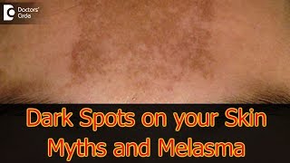 Dark Spots on your Skin  Hormones Vitamin D Melasma  Dr Aruna Prasad [upl. by Yenatirb]