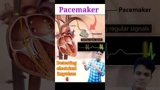 Pacemaker heart pacemaker shorts medical [upl. by Fante]