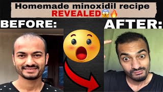 Homemade minoxidil making recipe finally revealed😱🔥 [upl. by Xuagram]