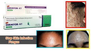 How to use Dermitor KT Cream  Beclomethasone Ketoconazole Dipropionate Neomycin  Antifungal [upl. by Lust]