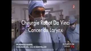 Da Vinci Robotic Surgery Laryngeal Cancer Montpellier FRANCE [upl. by Frasier]