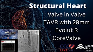 Valve in Valve TAVR with 29mm Evolut R CoreValve  January 8 2019 [upl. by Oiuqise]