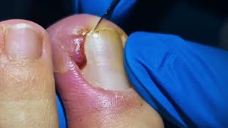 WARNING Dont Try Ingrown Toenail Removal Without Watching This [upl. by Salohci]