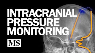 External Ventricular Drainage and Intracranial Pressure Monitoring [upl. by Adoc30]