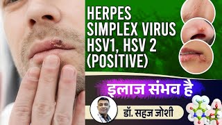 Herpes Simplex Virus  hsv1 Positive  hsv2 Positive  Genital Herpes Permanent Treatment [upl. by Valerye]