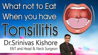 Hi9  What not to Eat when you have Tonsillitis  Dr Srinivas Kishore  Ent and HeadampNeck surgeon [upl. by Zachar456]