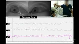 Upbeat and horizontal gazeevoked nystagmus in bilateral medial medullary infarction [upl. by Kingdon]