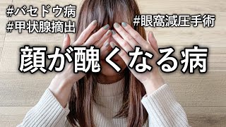 【バセドウ病】顔が醜くなる病気になりました…甲状腺眼症眼球突出甲状腺全摘出手術ステロイドパルス眼窩減圧手術 [upl. by Adnawahs]