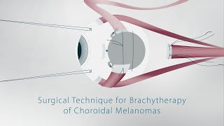 Surgical Technique for Brachytherapy of Choroidal Melanomas [upl. by Notgnirrab]