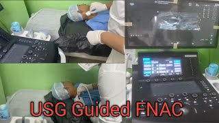 FNAC  Fine Niddle Aspiration Cytology  USG Guided FNAC  Procedure [upl. by Anoif]