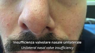 Insufficienza della valvola nasale dilatatore nasale vs cerotto nasale [upl. by Nojel]