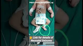 Neonatal Clonic Seizure [upl. by Drofniw841]