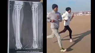 fullrecovery after tibia bone fracture [upl. by Atsylak]