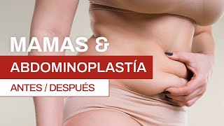 ¿Cómo se realiza una abdominoplastía Antes y después  Clínica Barrenechea [upl. by Artied]