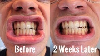 Teeth Whitening  BlanX White Shock with LED Bite  Review [upl. by Clynes]