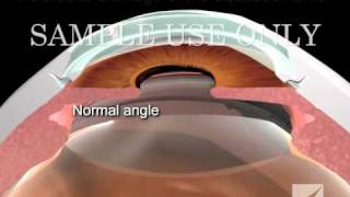 Diagnosis and Treatment of Closed Angle Glaucoma [upl. by Ehrsam199]