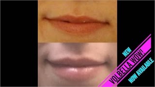 Juvederm Volbella Lip Filler Injection  Dr Rostami  Northern Virginia Washington DC Maryland [upl. by Eirallam]