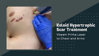 Keloid Hypertrophic Scar Treatment  Vbeam Prima Laser to Chest and Arms Dr Jason Emer [upl. by Airbmak]