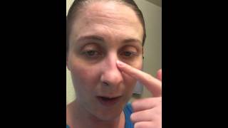 Day 2  Septoplasty and Bilateral Turbinate Reduction Surgery Recovery [upl. by Ttelrats818]