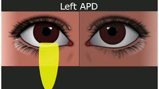 Relative Afferent Pupillary Defect  Medical Student Education [upl. by Auhesoj]