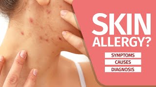 What is Skin Allergy Symptoms Causes Diagnosis and Triggers [upl. by Ardnalahs]