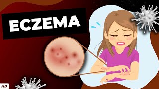 Eczema Everything You Need To Know [upl. by Quinton]