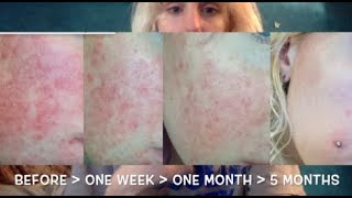 5 month vitamin update  CURING rosacea [upl. by Enitsuj548]