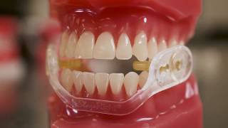 Which Dental Guard is the right fit [upl. by Welch]