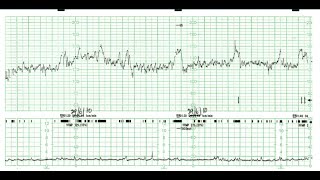 How to read a Cardiotocography CTG [upl. by Ifill]