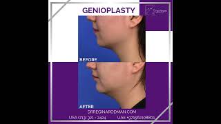 Genioplasty [upl. by Einaj]