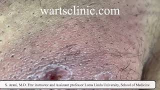 Molluscum self treatment causing deep skin infection and abscess [upl. by Bridgid]