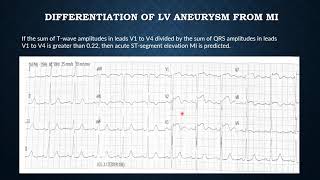 ST ELEVATION I ECG I ECHOCARDIOGRAM I DIFFERENTIAL DIAGNOSIS I MI I LV ANEURYSM [upl. by Derrej]