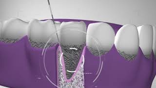 Curetaje higiene dental Te explicamos el procedimiento en Dentix [upl. by Dunham]