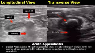 Appendix Ultrasound Reporting  Appendicitis Scan Reports  How To Write USG Report  Abdominal USG [upl. by Leval945]