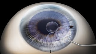 DMEK Descemets membrane endothelial keratoplasty animation [upl. by Ydollem]