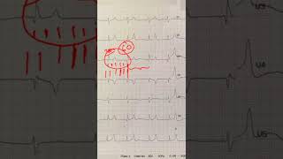 Hyperkalemia  Peaked TWaves  and ECG Recognition [upl. by Stila]