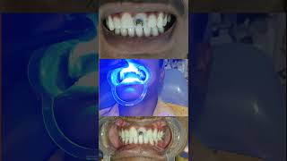 Front tooth composite filling for caries tooth brokenteeth compositefilling [upl. by Atiraj]