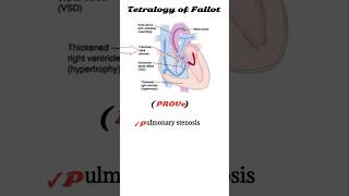 tetralogy of fallot mnemonic  TOF [upl. by Aileme]