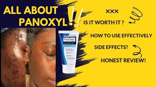 PANOXYL Face wash GAMEchanger for ACNE  HONEST REVIEW panoxyl skincareacne [upl. by Kentigera650]