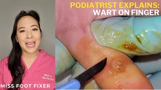 Wart Removal Techniques How To Use Silver Nitrate amp Immune Response To Fight HPV  Miss Foot Fixer [upl. by Nimesay]