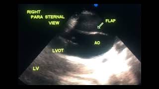 Asymptomatic dissection of aorta to drahmadmirdamadisiJSbA7GCDIDSLEpD [upl. by Mada]