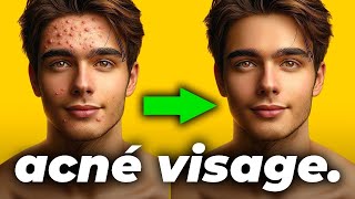 ❌ BOUTONS D’ACNÉ VISAGE  Comment en Finir Définitivement ✅ [upl. by Isman]