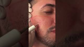 Tratamento de cicatrizes de acne com jato de plasma [upl. by Kentiga777]