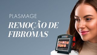 PLASMAGE  Remoção de Fibromas [upl. by Draude]