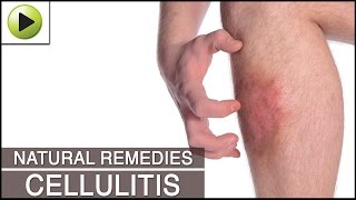 Home Remedies for Cellulitis [upl. by Alleunamme999]