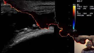 Quadriceps Tendon Rupture MSK Ultrasound [upl. by Rosol554]