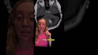 Case study 124  Pilocytic astrocystoma EXPLAINED by a boardcertified neurosurgeon [upl. by Dolores424]