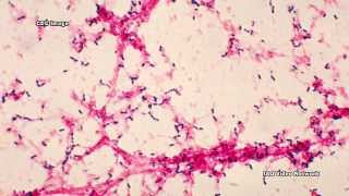 Bacterial Meningitis [upl. by Kissner]