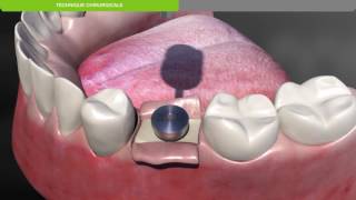 Biotech Dental Protocole chirurgical de pose dun implant dentaire KONTACT souscrestal [upl. by Eecart]