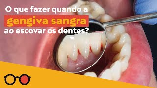 Sua gengiva sangra ao escovar os dentes  plantão de dúvidas [upl. by Krilov653]